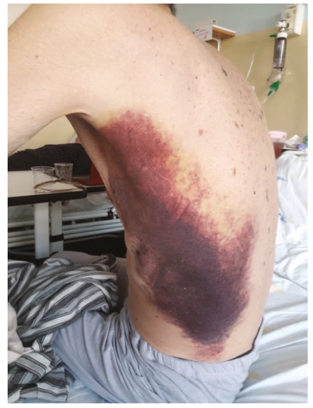 Spontánnĕ vzniklé podkožní hematomy