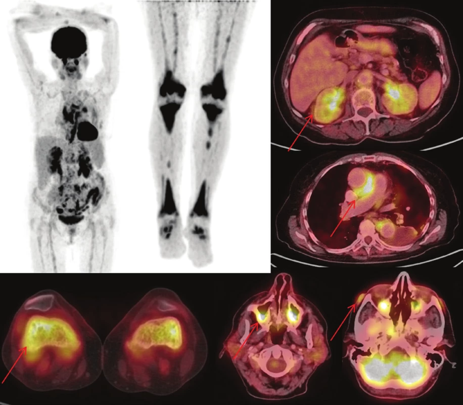 (vlevo) Sumarizace nálezů <sup>18</sup>F-FDG
PET/CT vyšetření u pacienta č. 3. Černobílé
MIP projekce ukazují rozsah snímání,
odráží i rozsah kostního postižení. Fúzované
obrazy pak ukazují detaily retroperitoneálního,
kardiovaskulárního, kostního,
paranasálního, orbitálního a kožního postižení.