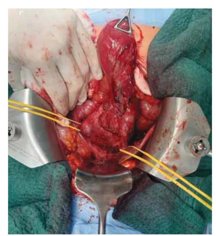 Operace: exstirpace ložiska s přilehlým žlučníkem
a žlučovými cestami.<br>
Fig. 5. Surgery: extirpation of the lesion with the adjacent gallbladder
and bile ducts.