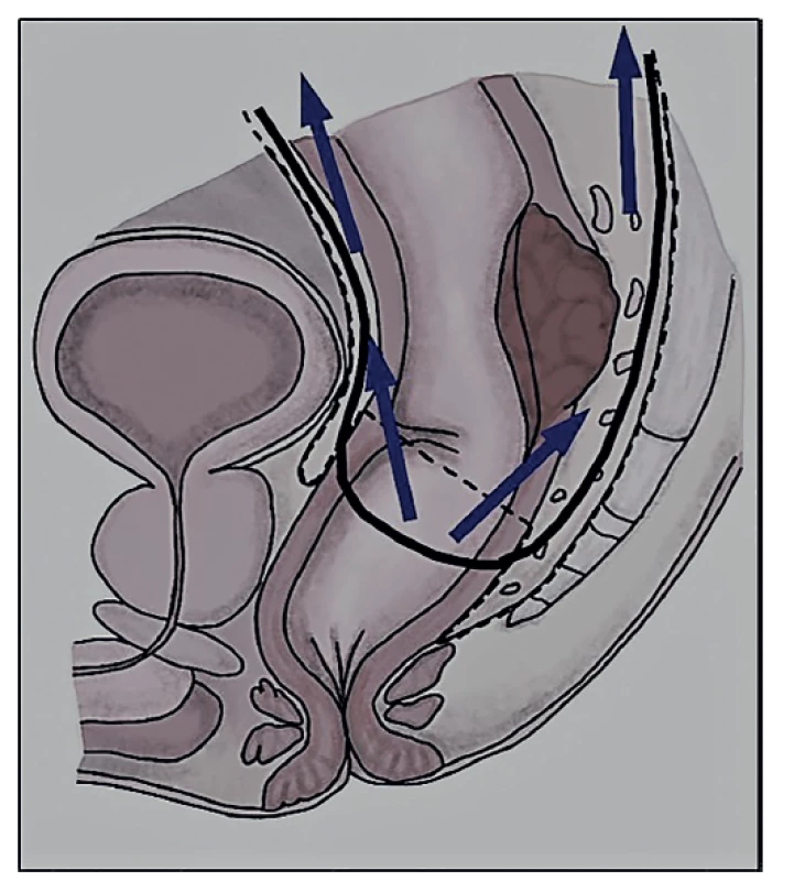 Schéma transanální totální mezorektální excize
(bottom-up approach)<br>
Fig. 2: Transanal total mesorectal excision scheme (bottom-
-up approach)