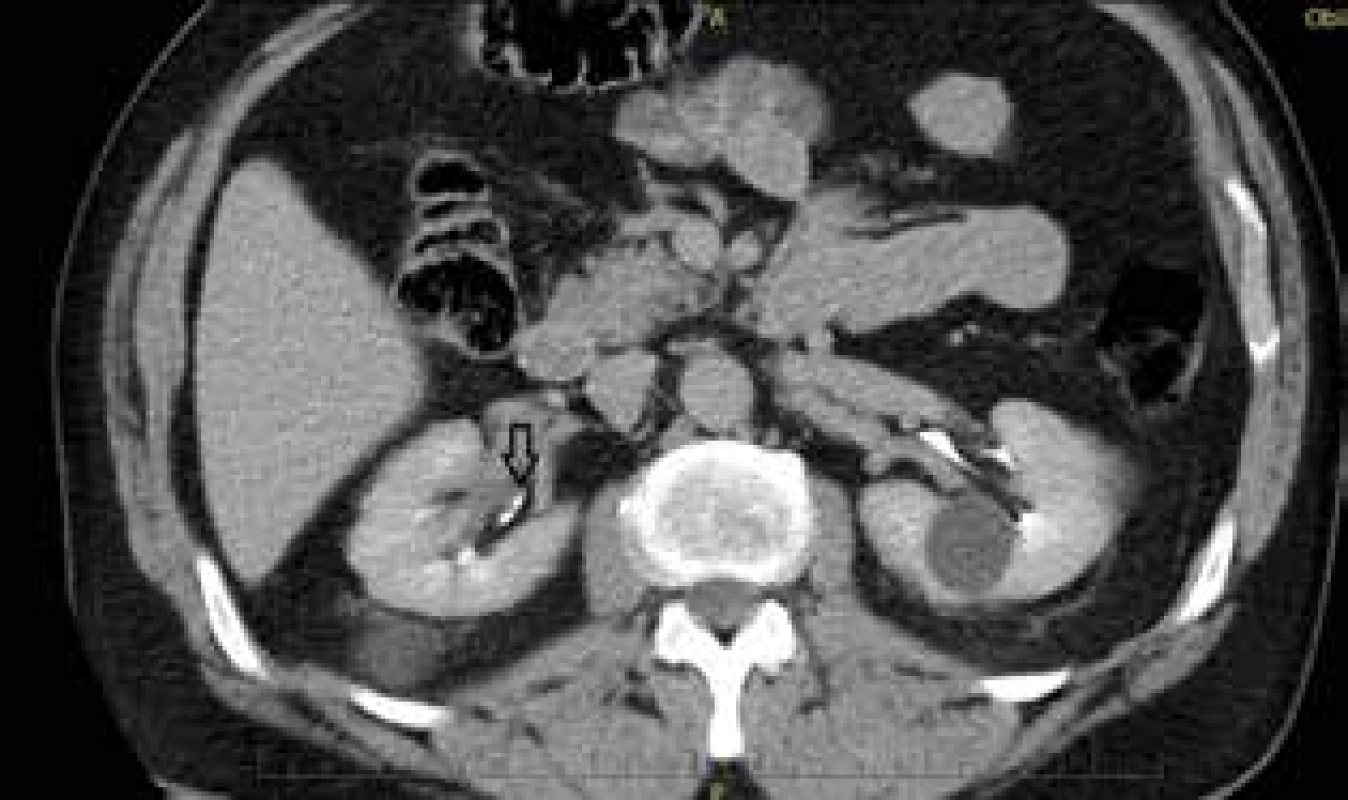 Uroteliální karcinom pánvičky pravé ledviny – CT <br>
Fig. 10: Urothelial carcinoma of the renal pelvis of the right
kidney − CT