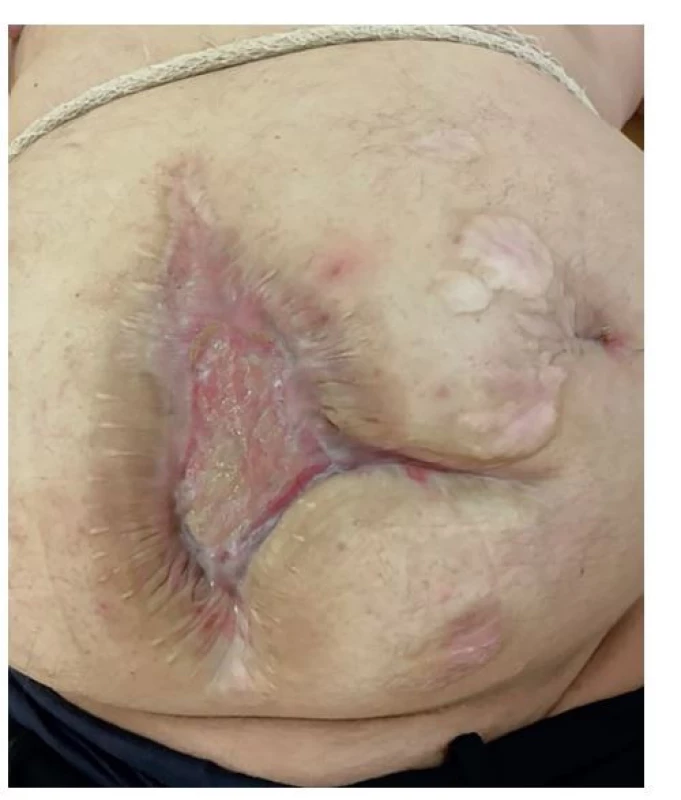 Chronický defekt stěny břišní předoperačně<br>
Fig. 1: Chronic defect of the abdominal wall in the preoperative
period