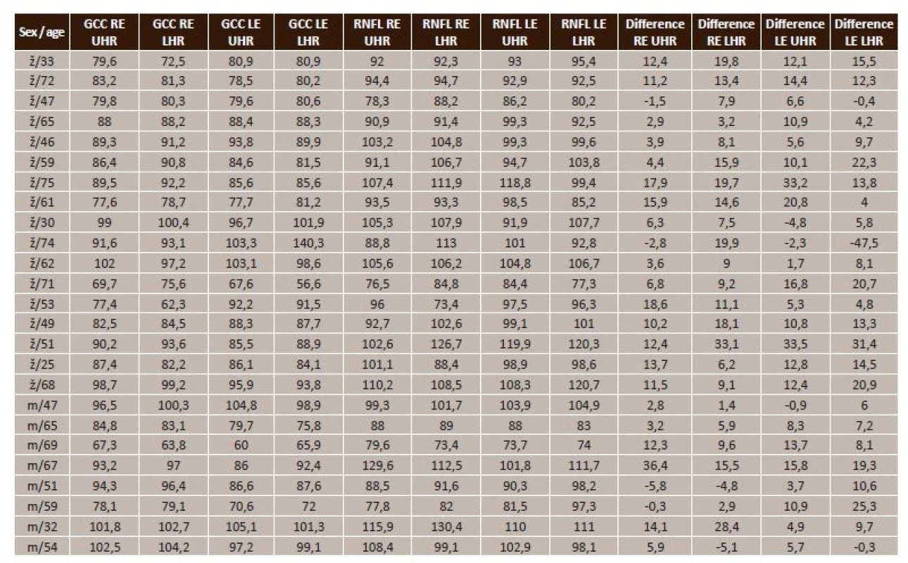 Summary table of measured values in NTG (F/33 = female/33 years, M/47 = male/47 years, GCC = ganglion cell complex, RE = right eye, LE = left eye, UHR = upper half of retina, LHR = lower half of retina, RNFL = retinal nerve fibre layer, Difference = RNFL-GCC
