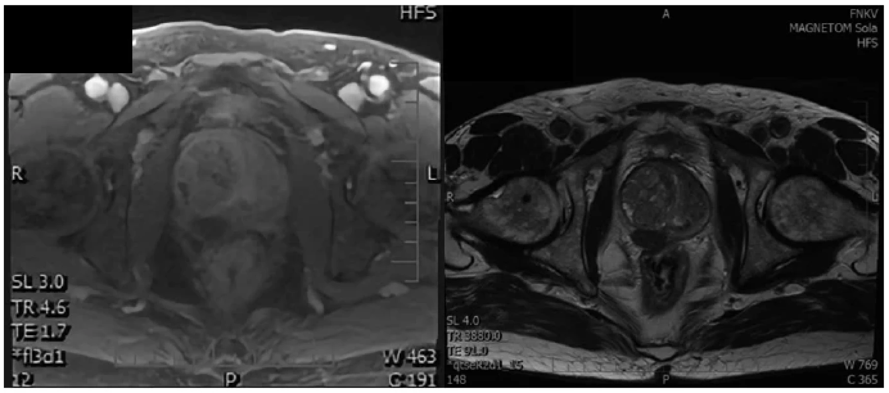 MRI prostaty, ložisko v T1 a T2 zobrazení <br> 
Fig. 2. MRI prostate, lesion in T1 fat sat contrast and T2 sequences