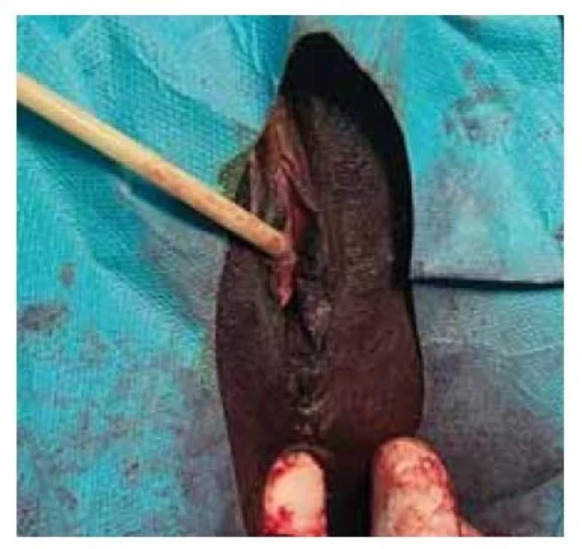Po výkonu, publikováno se
svolením pacientky.<br>
Fig. 2. After the procedure, published
with the permission of the patient.