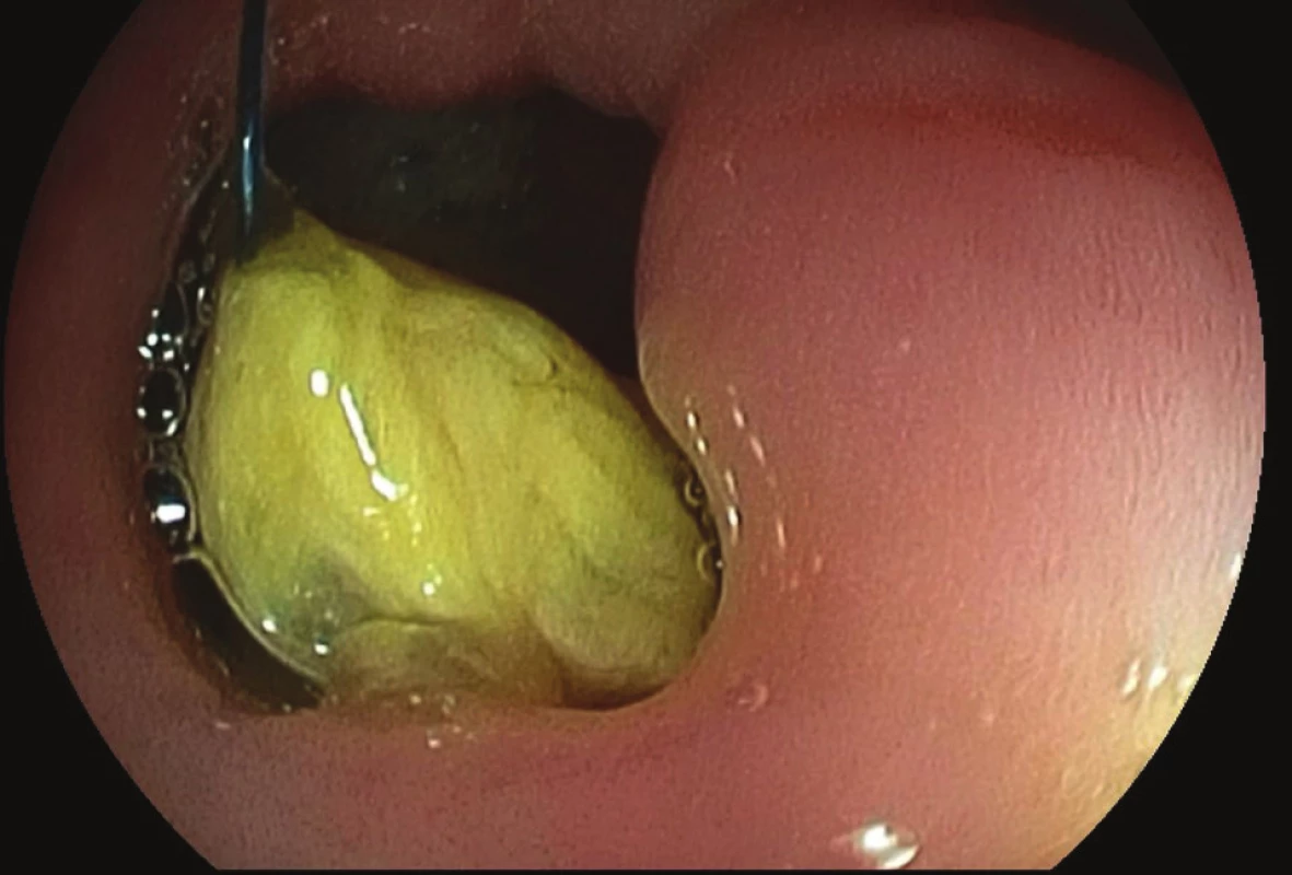 Gastroskopie po LGCP s nálezem bezoáru kolem
stehu<br>
Fig. 1: Gastroscopy with finding of bezoar around the
sewing material