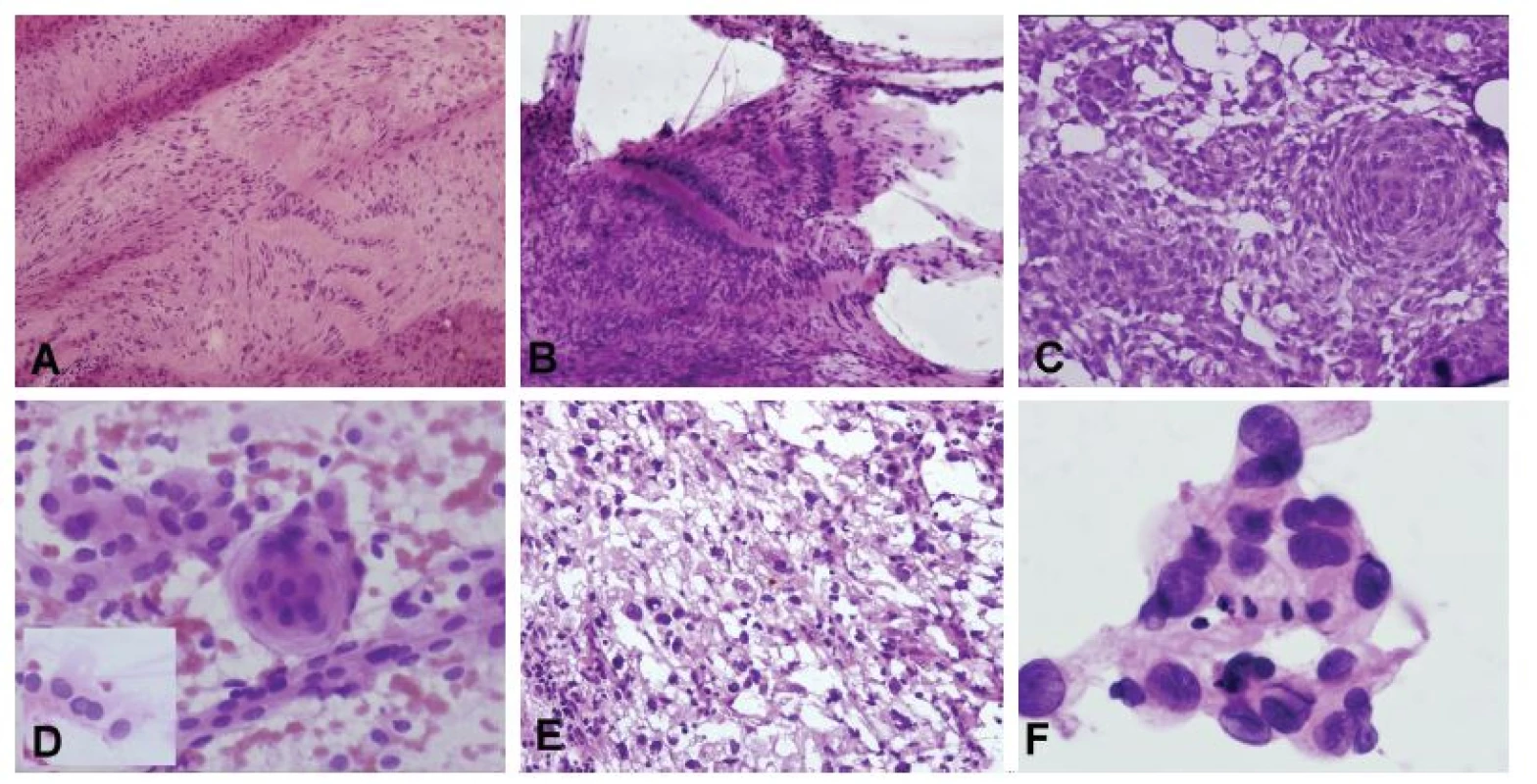 (A, B) Tumor pontocerebelárneho uhla u 53-ročného muža. V zmrazenom reze bola zachytená lézia bohatá na kolagénnu matrix a vretenitými bunkymi
s hyperchrómnymi pretiahnutými jadrami s naznačeným rytmickým/palisádujúcim usporiadaním (A). V náterovej cytológii prítomné iba zhluky tkaniva (žiadne
izolované bunky) zloženého z vretenitých buniek s tmavými jadrami, palisádovanie však bolo ložiskovo ešte výraznejšie ako v zmrazenom reze (B). Peroperačná
a definitívna diagnóza: schwannóm. (C, D) Tumor pontocerebelárneho uhla u 48-ročnej ženy. V zmrazenom reze je zachytená solídna proliferácia epiteloidných
buniek, s naznačenými vírovitými formáciami (C). V náterovej cytológii monotónna blandná populácia epiteloidných kohezívnych buniek (spojené širokým
pruhom cytoplazmy), ložiskovo s typickým vírovitým usporiadaním a jadrovými pseudoinklúziami (vložený obrázok) (D). Peroperačná diagnóza: meningióm.
Definitívna diagnóza: meningoteliálny meningióm, grade I. (E, F) 62-ročná žena so solídno-cystickým tumorom hemisféry mozočka. V zmrazenom reze bola
zachytená nádorová lézia tvorená bunkymi s vakuolizovanou cytoplazmou a atypickými hyperchrómnymi jadrami (E). V náterovej cytológii kohezívne fragmenty
tvorené epiteloidnými bunkami s atypickými jadrami a jemne vakuolizovanou cytoplazmou (F). Peroperačná a definitívna diagnóza: hemagioblastóm.