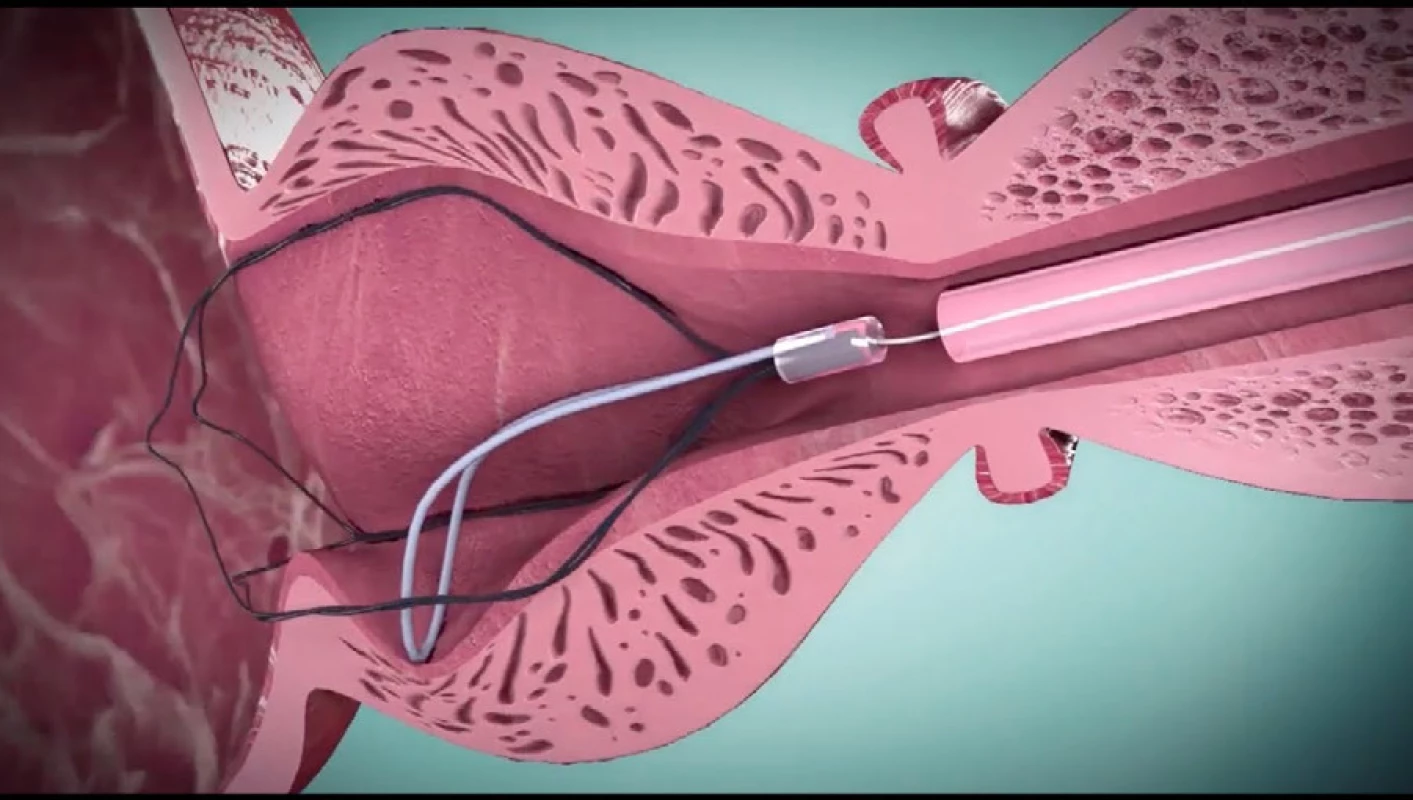 Ilustrační zobrazení roztažené nitinolové kličky TIND<br>
Fig. 4. Illustration of an expanded nitinol loop TIND