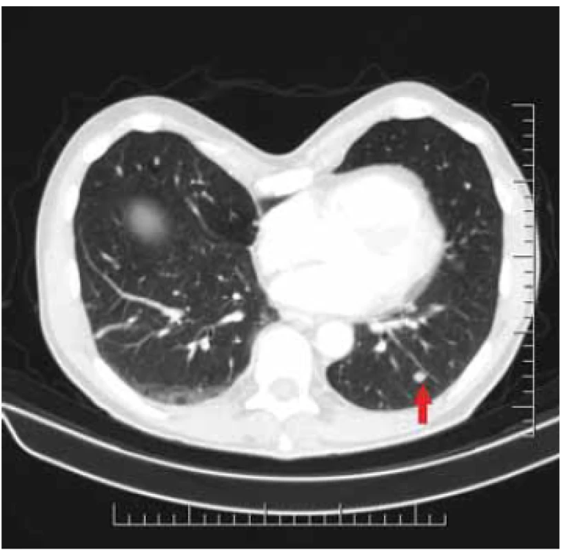 Metastases in pulmonary
parenchyme.<br>
Obr. 5. Metastázy v pľúcnom
parenchýme.