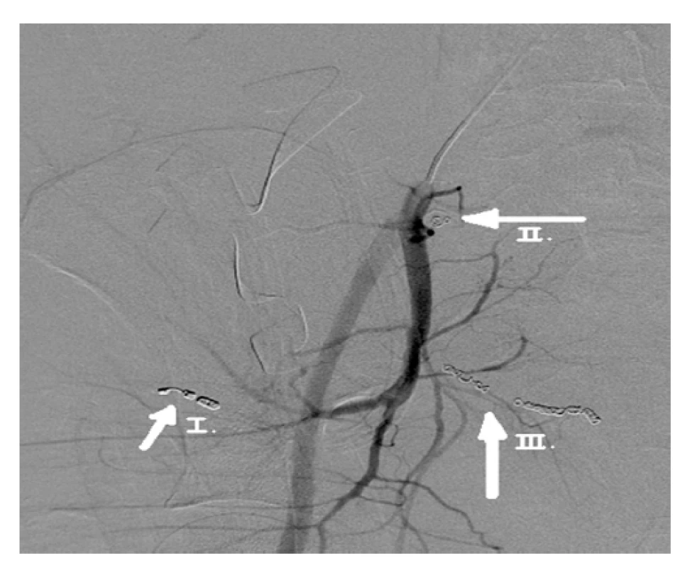 Netraumatické retroperitoneální krvácení u pacientky
s covid pozitivní respirační insuficiencí v povodí
pravé arteria iliaca interna, endovaskulární angioembolizace
pomocí coilů, ošetření zdroje krvácení − I. arteria
glutealis, II. arteria iliolumbalis, III. arteria uterina<br>
Fig. 4: Non-traumatic retroperitoneal hemorrhage in
a patient with covid positive respiratory insufficiency in
the region of the right arteria iliaca interna; endovascular
coil angioembolization, treatment of the source of bleeding
− I. arteria glutealis, II. arteria iliolumbalis, III. arteria
uterina