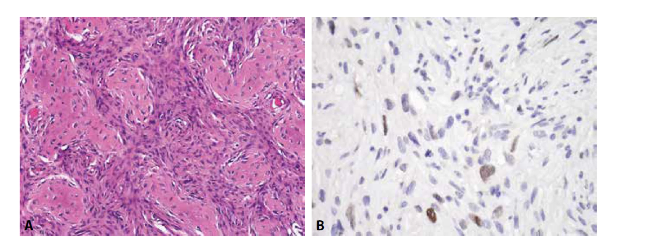 Low-grade centrální osteosarkom. A) oproti fibrózní dysplázii je tumor celulárnější (H&E); B) sporadická exprese MDM2 v oválných
buňkách (zvětšení x 200).