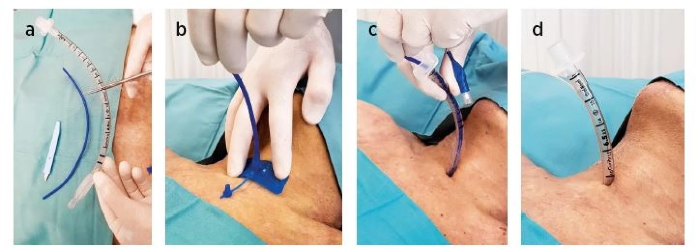 CO-BACT technika – jednotlivé kroky
a) zkrácení standardní endotracheální rourky, b) znovuzavedení bužie ze setu, c) přetažení tracheální rourky po bužii, d) zavedená tracheální rourky