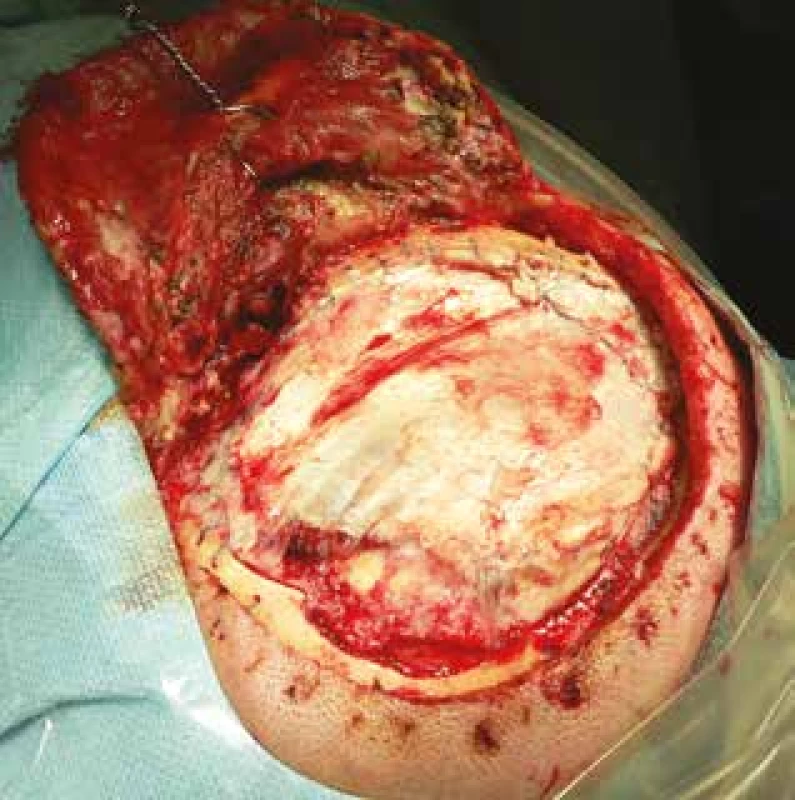 Revizní operace pro recidivující likvoreu po exstirpaci
meningeomu. Plastika defektu tvrdé pleny štěpem
z fascia lata a aplikací tkáňového lepidla.<br>
Fig. 3: Repeated surgery for CSF leakage. Dural reconstruction
with fascia lata and application of fibrin tissue
glue.