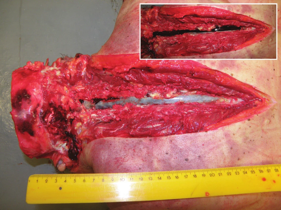Dorsal view of the cervical and mid-thoracic epidural space with subdural
hematoma visible through the intact dura mater. The dura is incised to
show the spinal subdural hematoma in situ (inset).