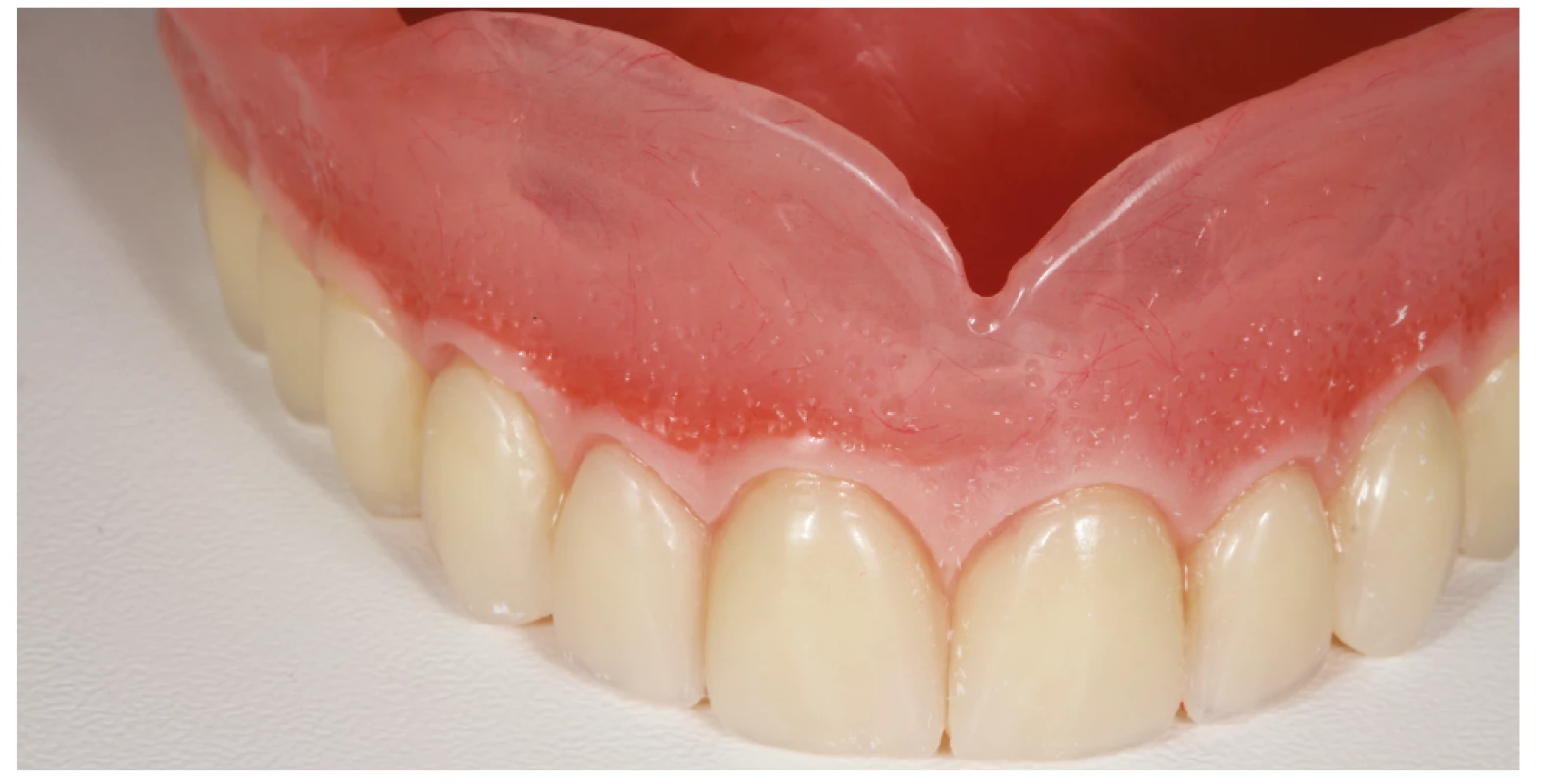 Zhotovená horní totální
náhrada<br>
Fig. 4
The upper complete denture