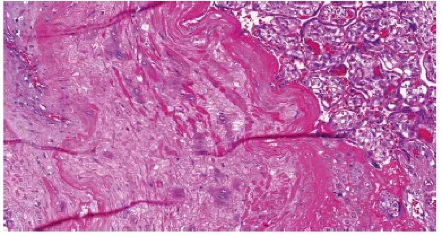 Placenta accreta. Choriové klky jsou od myometria odděleny pouze
vrstvou fibrinu, v němž jsou rozptýleny buňky extravilózního trofoblastu
(HE, 200x).