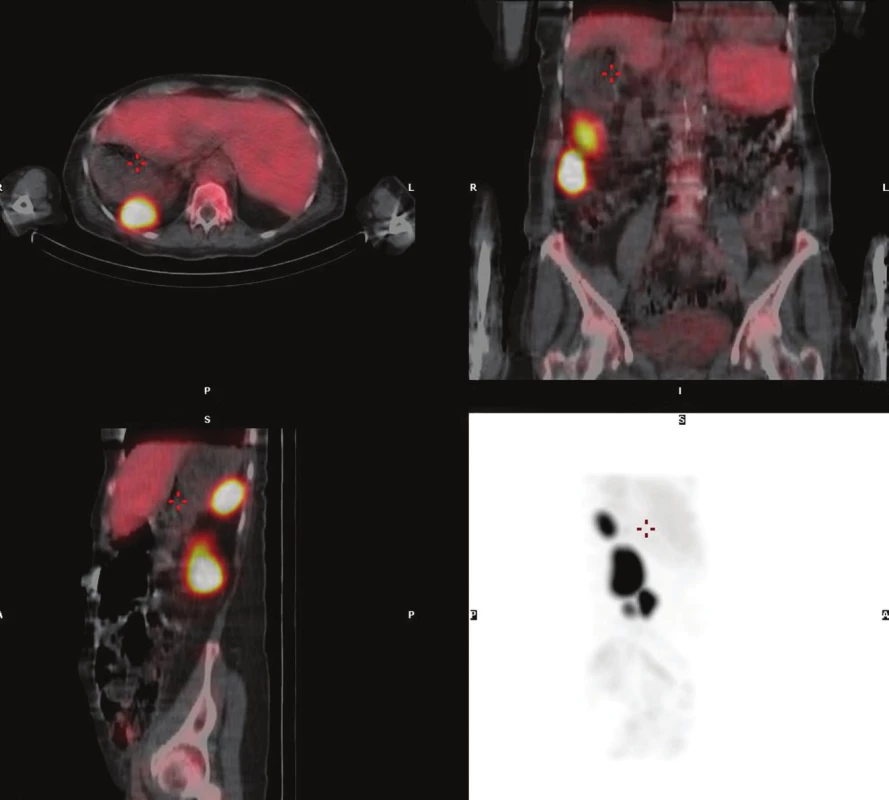 SPECT/LDCT břicha: zachycené okrsky slezinné tkáně (šipky).
