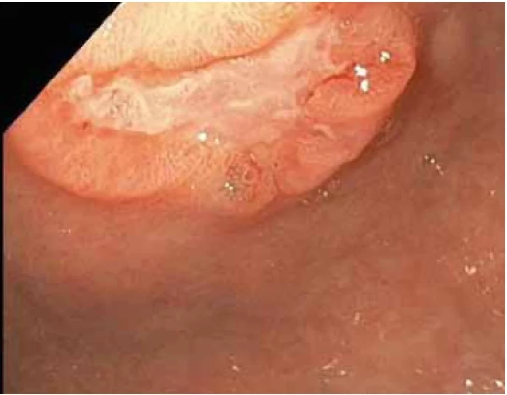 Vředová léze na přední stěně na přechodu těla a antra žaludku – první kontrolní gastroskopie.</br>Fig. 2. Ulcer lesion on the front wall at the junction of the body and antrum of the stomach – the first control gastroscopy.