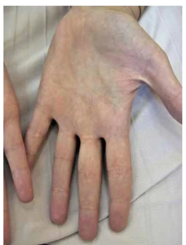 Xanthoma striatum palmare u 30leté nemocné
s ulcerózní kolitidou a primární sklerotizující cholangitidou