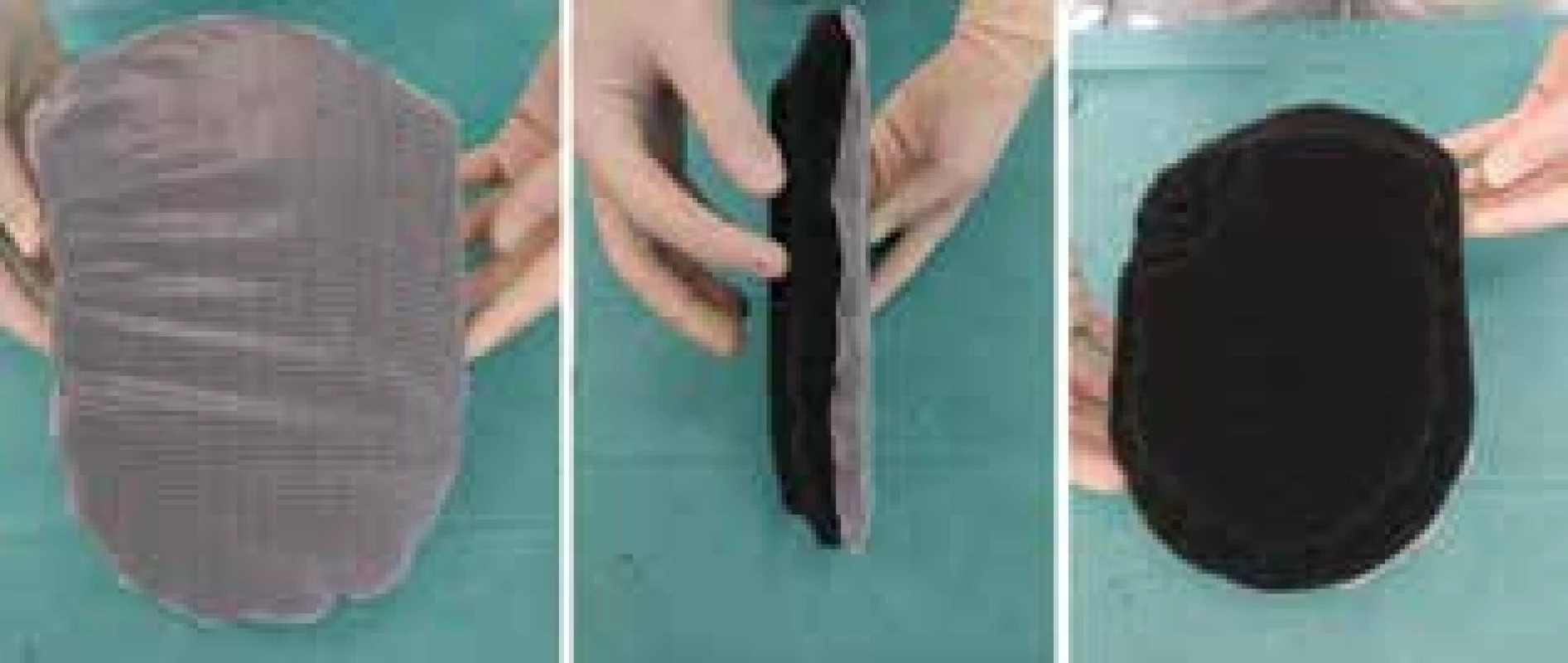Pěna s našitou silikonovou kontaktní vrstvou <br>Fig. 3: Foam witha silicone contact layer fixed by sutures
