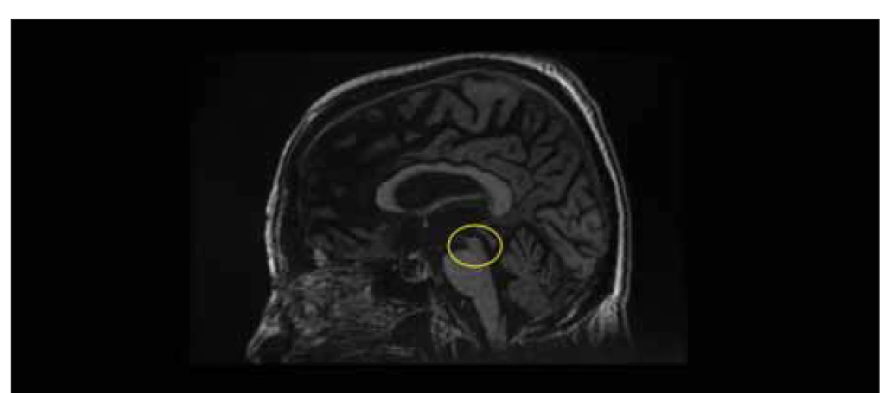 MR, T1-vážený obraz, sagitální rovina. Příznak kolibříka (mezencefalon ve žlutém
kruhu) u pacientky po implantaci zkratu na 3měsíční kontrole. Po krátkém iniciálním
zlepšení symptomů idiopatického normotenzního hydrocefalu došlo u pacientky k rozvoji
progresivní supranukleární obrny a rychlé klinické deterioraci.<br>
Fig. 6. MRI, T1-weighted image, sagittal plane. Hummingbird sign (mesencephalon in
a yellow circle) in a female patient after shunt implantation at a 3-month follow-up. After
a brief initial improvement of idiopathic normal pressure hydrocephalus symptoms, the
patient developed progressive supranuclear palsy and rapid clinical deterioration.