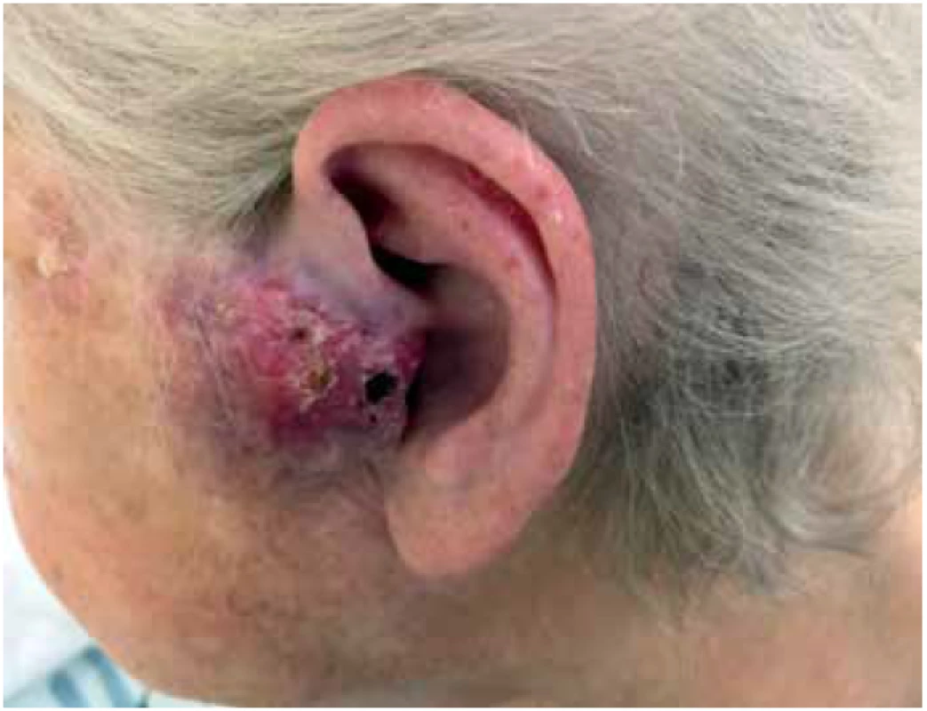 Částečně ulcerovaný nafialovělý objemný uzel preaurikulárně vlevo, zčásti infiltrující tragus.