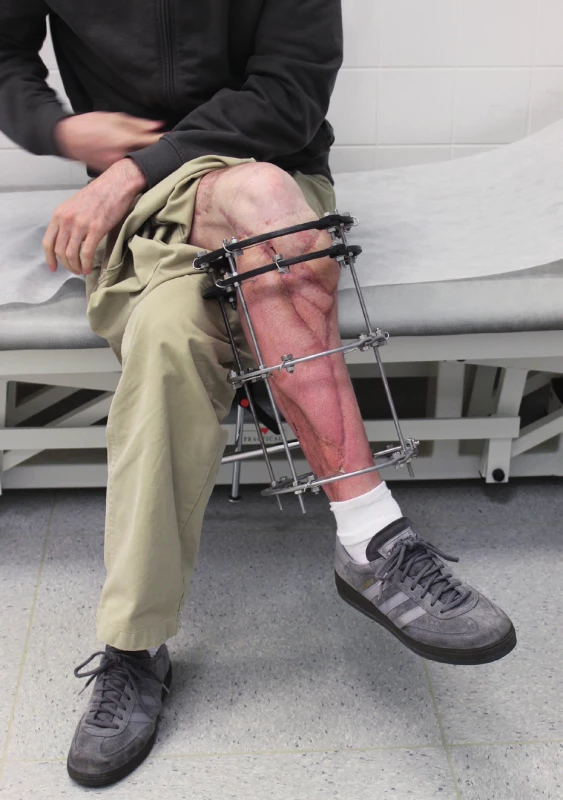 The periosteal part of the MFC flap was fixed and
stabilised in tibia defect with Ilizarov fixator. Six weeks after the
final reconstructive procedure, the patient was capable of full
range of motion in the knee
