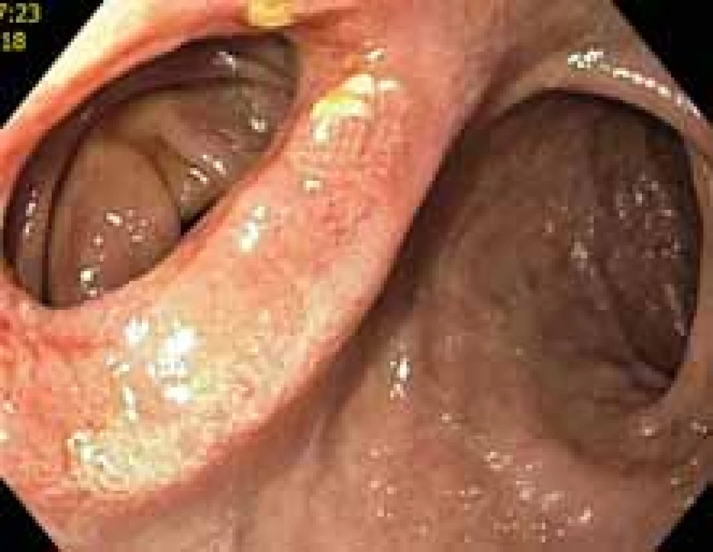 Duodenojejunoanastomóza
po extrakci lumen apozičního metalického
stentu. Vlevo pohled do pahýlu
jejuna, vpravo pohled do lumen
duodena.<br>
Duodenojejunoanastomosis
after extraction of lumen-apposing
metal stent. Left view of the jejunum
stump, right view of the duodenum
lumen.