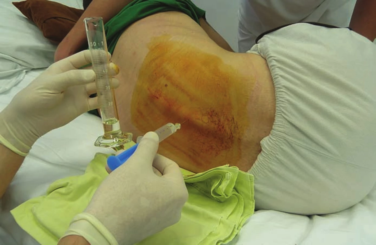Baklofénový test – jednorazové intratekálne podanie baklofénu lumbálnou
punkciou.<br>
Fig. 1. Intrathecal baclofen screening test – injection of a test dose of baclofen into the
intrathecal space.
