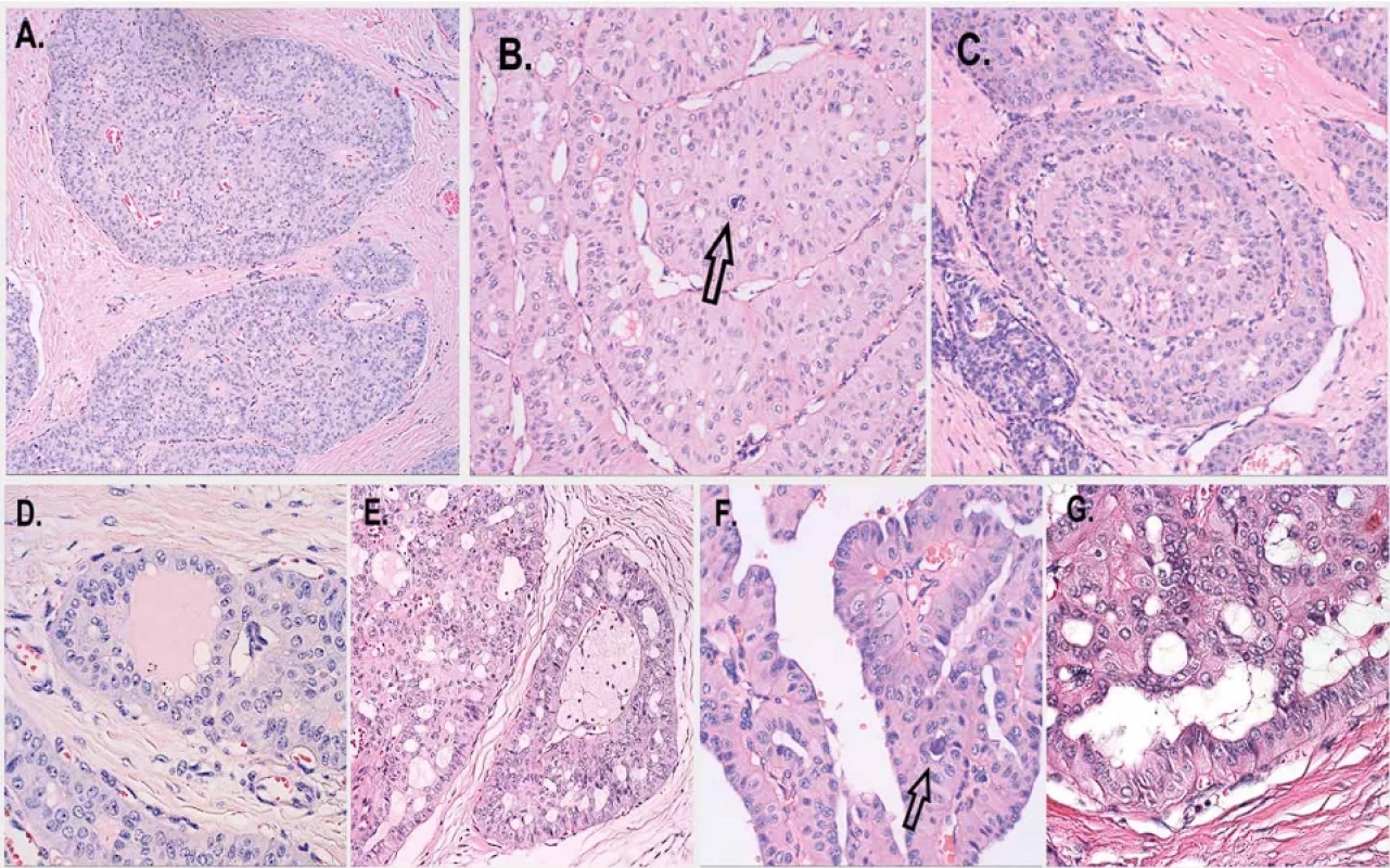 Histologický obraz TCCRP. A. Štruktúry pripomínajúce vývody distendované intraluminálnou proliferáciou s komplexnou solídne papilárnou mikroarchitektonikou a zvýraznenou fibro-vaskulárnou kresbou (Farbenie H&E; zväčšenie x100); B. V niektorých štruktúrach známky kribriformných fenestrácií; šípkou označený dystrofický mikrokalcifikát (Farbenie H&E; zväčšenie x200); C. Tvorba intraluminálnych targetoidných papilárnych formácií ( Farbenie H&E; zväčšenie x200); D. Niektoré luminá vyplnené eozinofilným sekrétom pripomínajúcim thyreoidálny koloid, resp. v E s penovitými makrofágmi (oba farbenie H&E; zväčšenie x200); F. a G. Detail na kolumnárnu bunkovú populáciu s vyznačenou stratou nukleárnej polarity, v F je šípkou označený dystrofický mikrokalcifikát (oba farbenie H&E; zväčšenie x400). 