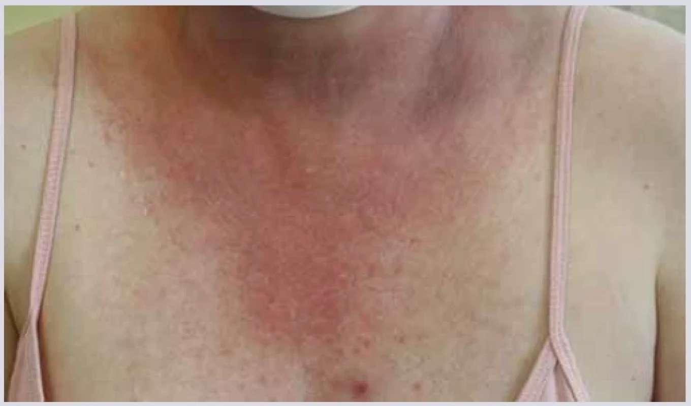 Lupus-like syndrom. <br> 
Fig. 7. Lupus-like syndrome.
