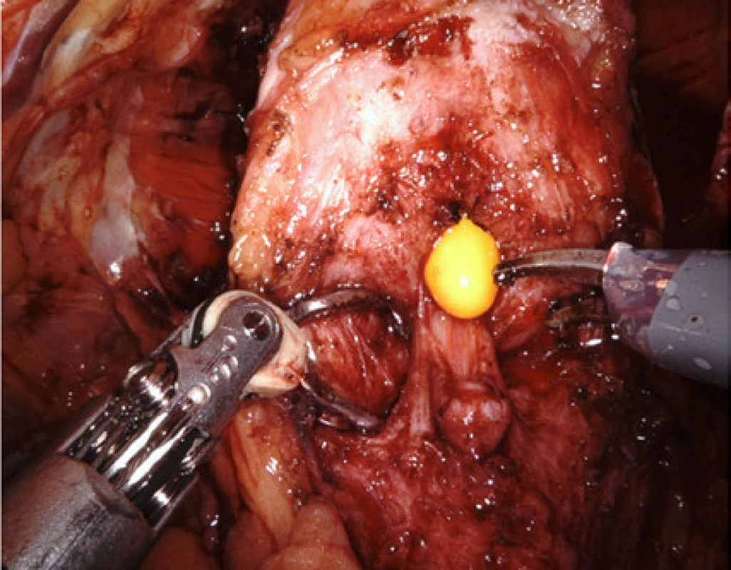 Na snímku je vidět vtažení cévky do prostaty
tak, aby byla přístupná zadní strana hrdla k odstřižení<br>
Fig. 5. The catheter has been retracted into the prostate
in order to make the posterior aspect of the bladder neck
accessible for dissection 
