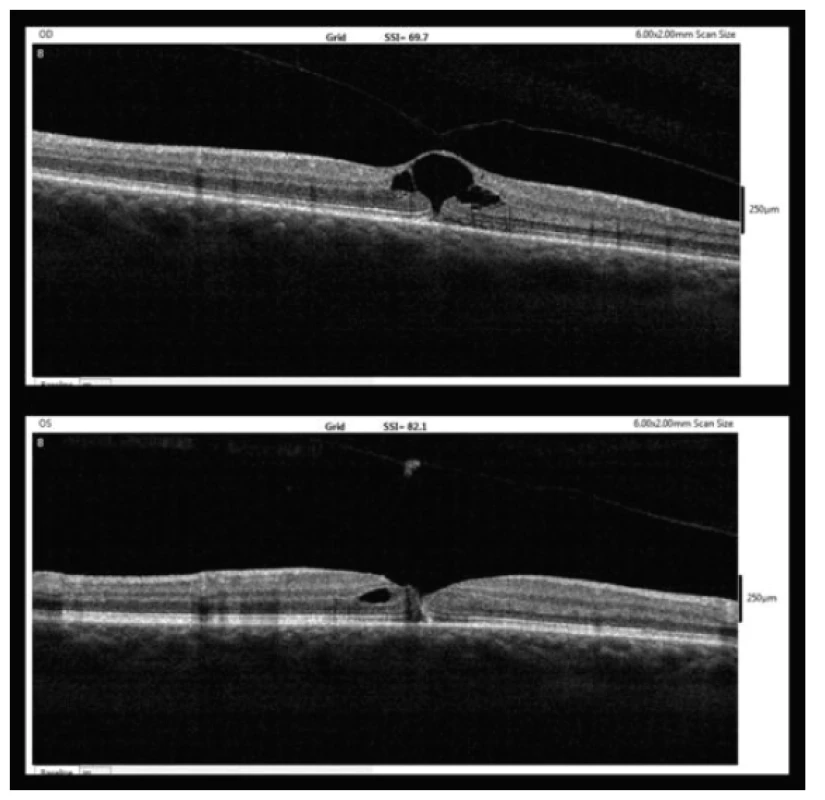 OCT findings one week after MH diagnosis (upper – right
eye, lower – left eye)