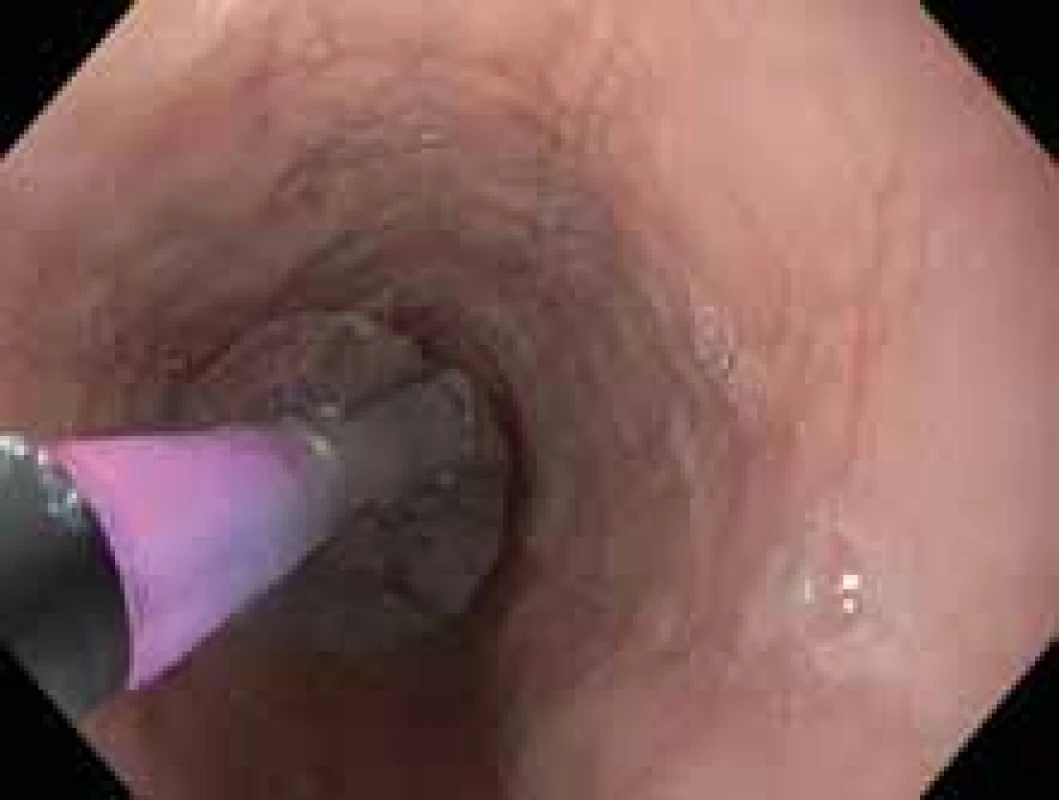 Pneumatická dilatace stenózy jícnu.<br>
Fig. 2. Pneumatic dilation of esophageal stenosis.