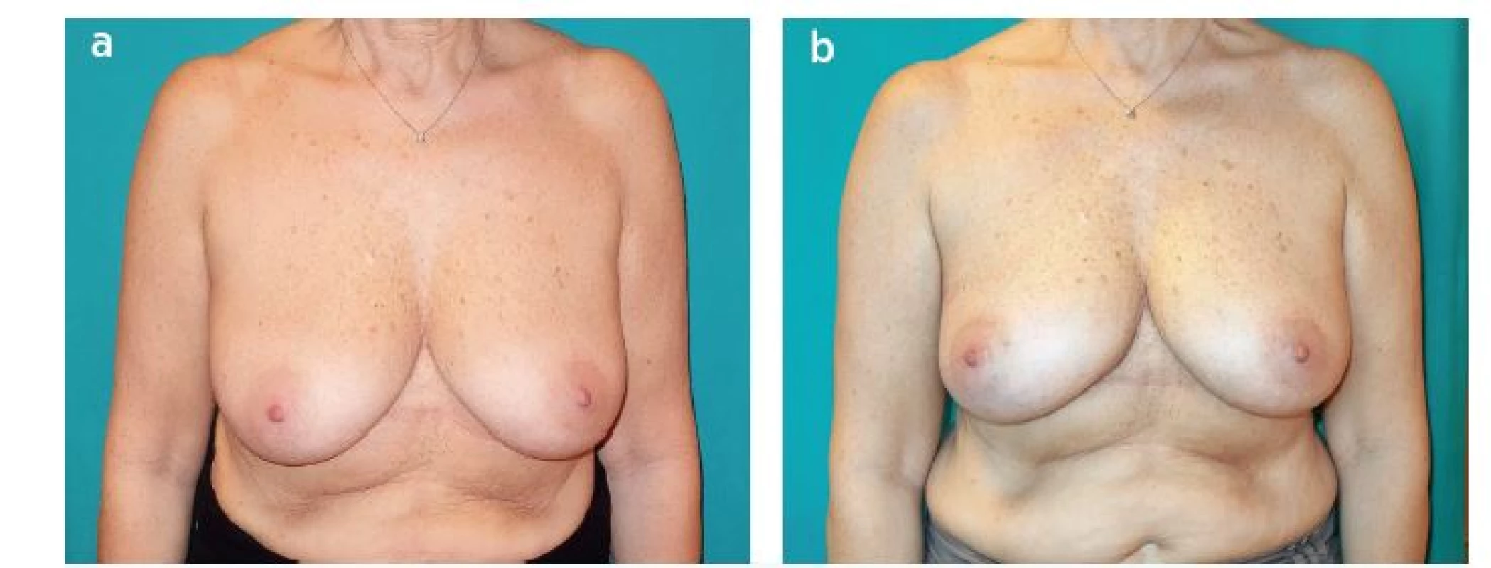 Patient with upper outer quadrant cancer of the right breast. Quadrantectomy, sentinel lymph node biopsy and reconstruction
with LICAP flap were performed. A: Preoperative view. B: One month postoperative view