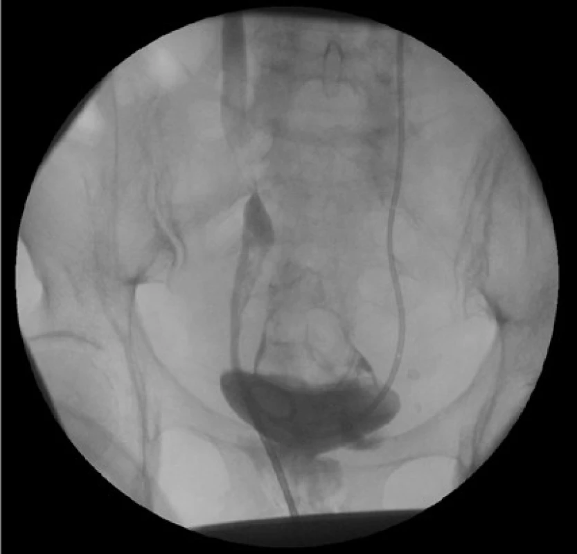 Ascendentní ureterografie s nálezem leaku kontrastní látky<br>
Fig. 4. Leakage of contrast agent during retrograde
ureterography