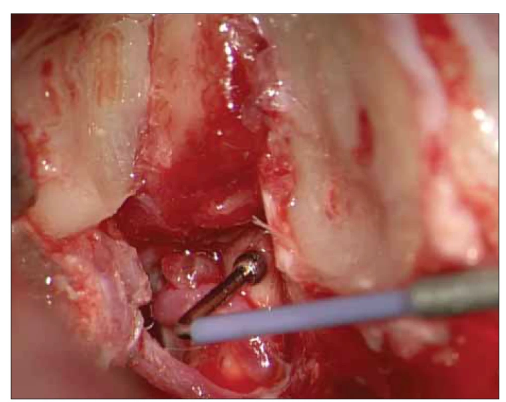 Sonda přiložená na uvolněný sluchový nerv ve vnitřním zvukovodu.<br>
Fig. 1. A probe attached to a loose auditory nerve in the internal auditory canal.
