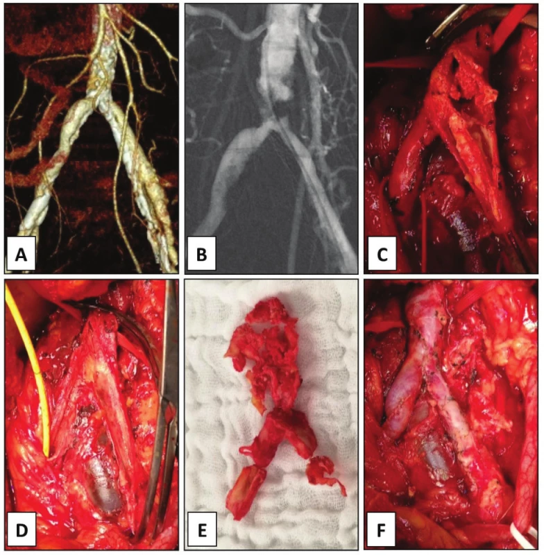 Endarterectomy of aortic bifurcation and common
iliac arteries, case 7.