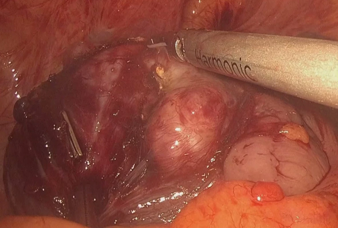 Tumor rekta a peritonea