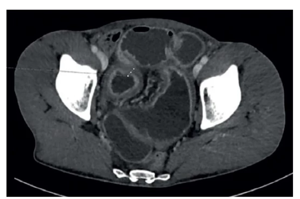 Axiální CT řez zobrazující zesílení stěny terminálního
ilea<br>
Fig. 1: Axial CT section showing hypertrophy of the terminal
ileum wall