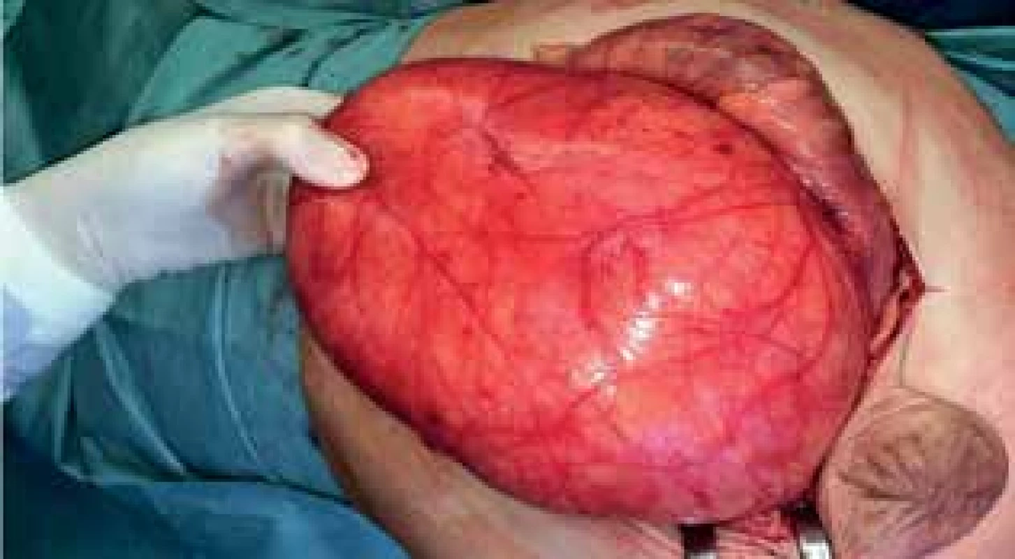 Peroperační nález liposarkomu<br>
Fig. 3: Peroperative finding of liposarcoma