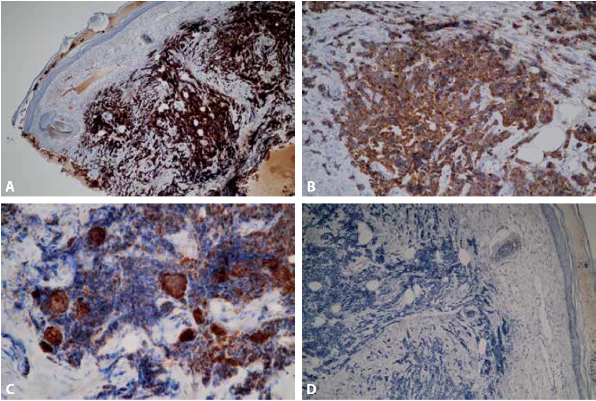 Imunohistochemický průkaz neuroendokrinní diferenciace: Silná pozitivita CD56 (A – zvětšení 100x) a silná cytoplazmatická pozitivita synaptophysinu (B – zvětšení 200x). Silná cytoplazmatická exprese AE1/AE3 v partiích se skvamózní diferenciací a slabá exprese v ostatních buňkách (C – zvětšení 200x). Negativní průkaz CK20 (D – zvětšení 100x).