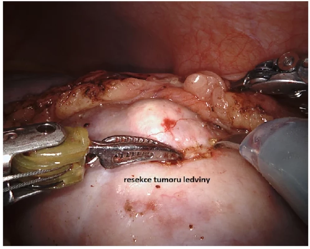 Robotická resekce tumoru ledviny <br> 
Fig. 6. Robotic resection of renal tumour