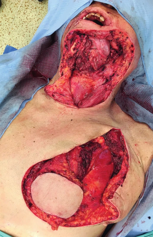 Raising of the PPM flap