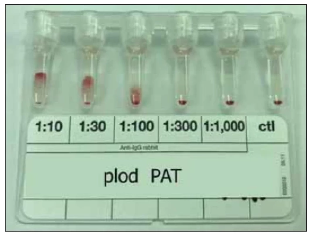 Přímý antiglobulinový test plodu v ředění
(DAT IgG-Dilution BioRad).