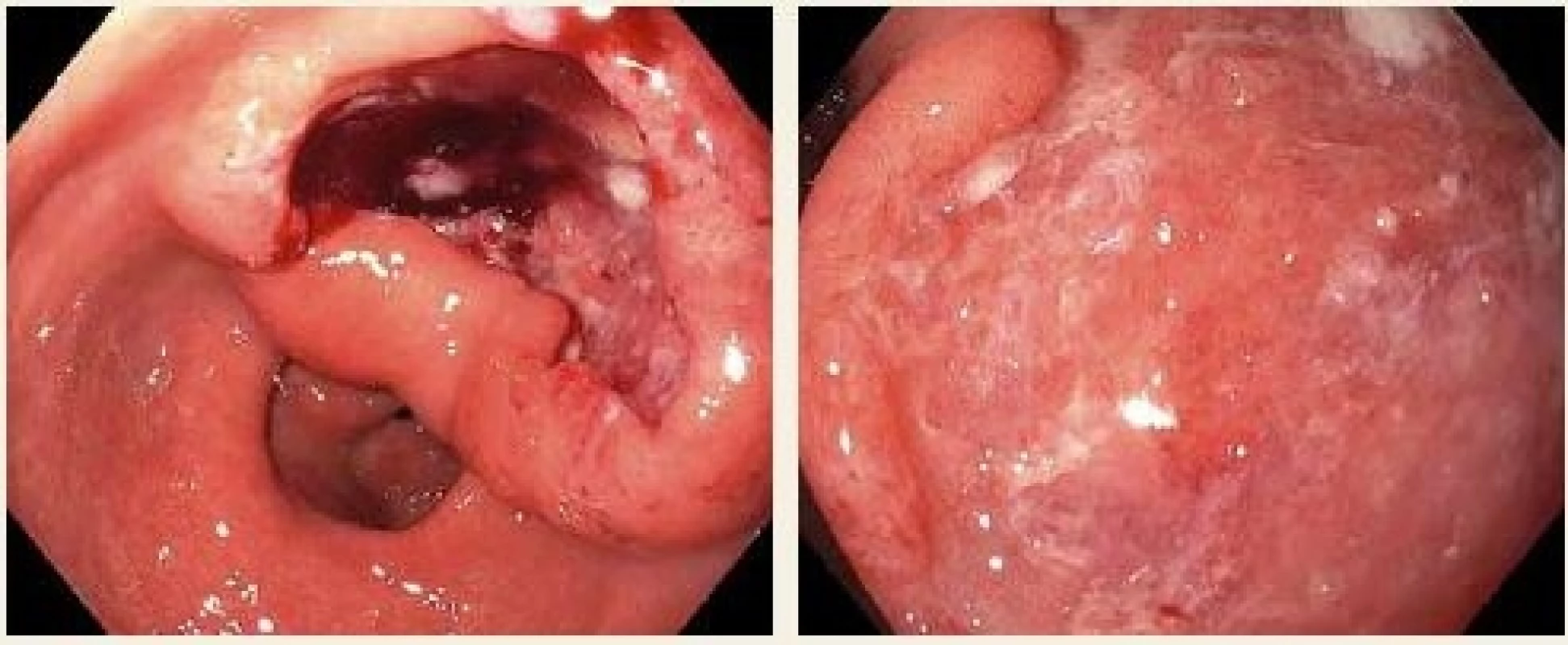 Patologie v oblasti výtokové a prepylorické oblasti žaludku, bez nepřímých známek evakuační žaludeční poruchy a bez známek recentního nebo hrozícího krvácení.