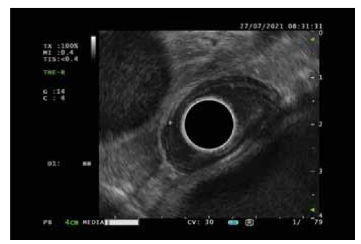 Subepiteliální, polypoidní léze o průměru 10 mm
zobrazena pomocí radiální EUS.<br>
Fig. 3. Subepithelial, polypoid lesion with a diameter
of 10 mm imaged using radial EUS.