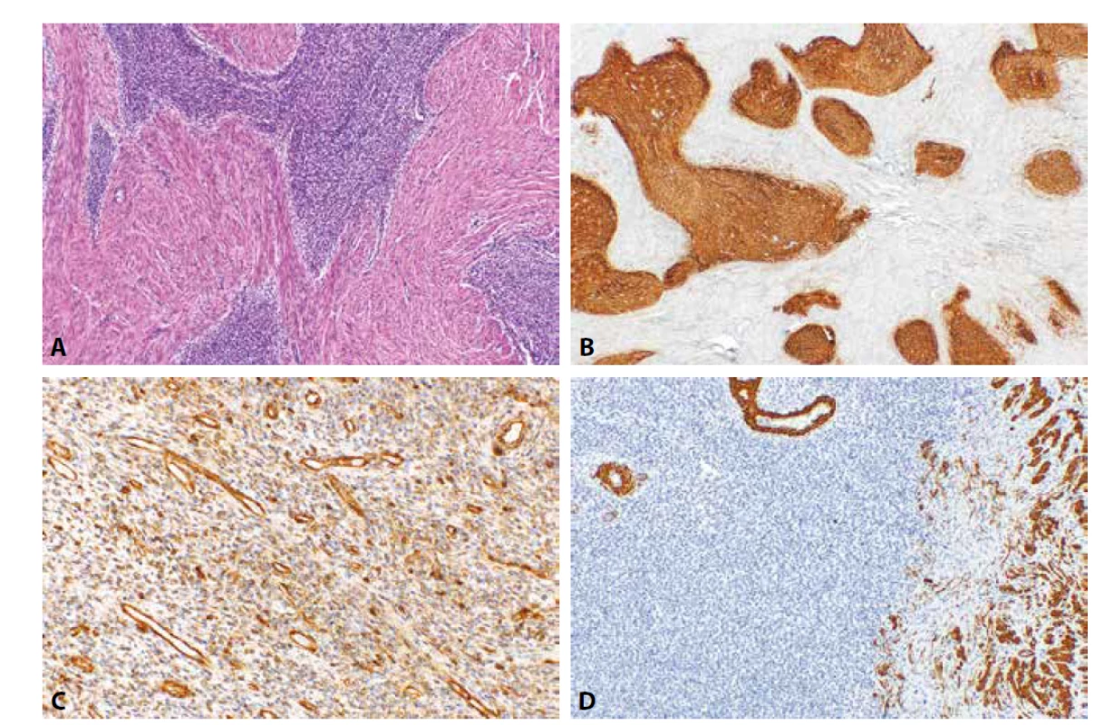 Low grade endometriální stromální sarkom. Nádorové struktury s jazykovitou infiltrací myometria (1A, HE, 100x). Nádorové buňky jsou
pozitivní při průkazu CD10 (1B, 40x), IFITM1 (2C, 200x) a negativní při průkazu h-caldesmonu (1D, 100x).