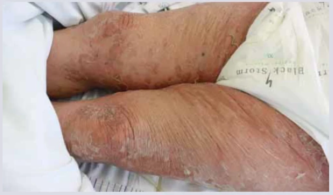 Toxická epidermální nekrolýza. <br> 
Fig. 14. Toxic epidermal necrolysis.