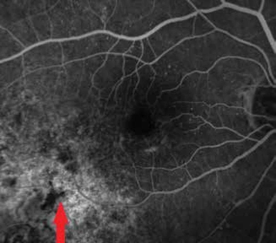 Fluoresceínová angiografia nádorového ložiska
o 4 roky neskôr v r. 2017